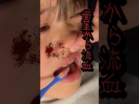 歯の矯正器具をつけたら歯茎から流血事件が…！？#歯 #反対咬合 #治療